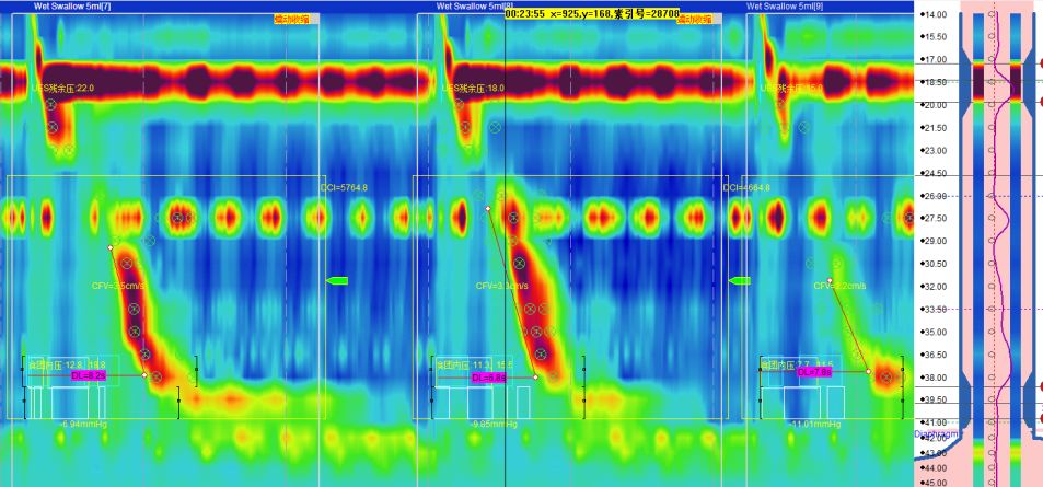 高分辨率食管测压——食管裂孔疝克星