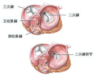 一,二尖瓣狹窄:二尖瓣狹窄往往伴有不同程度的關閉不全,但外科治療時