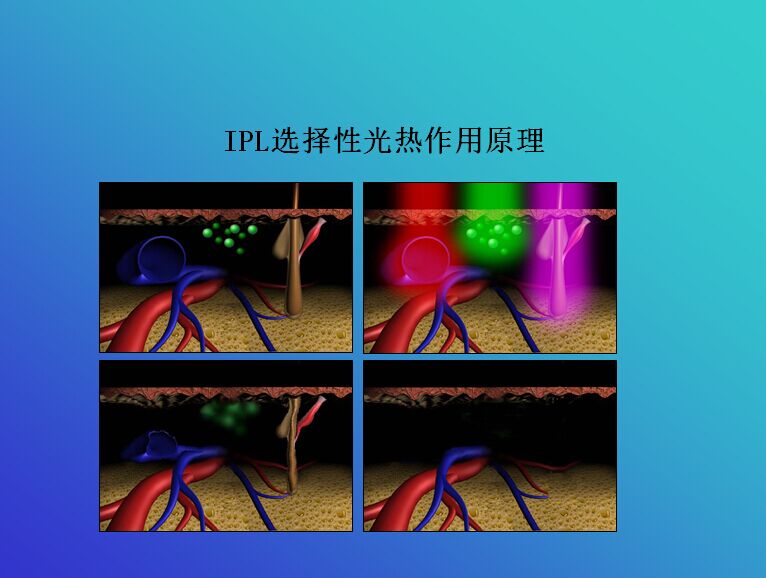 分享我的课件节选《强脉冲光应用进展》-赵小忠主任医师-爱问医生
