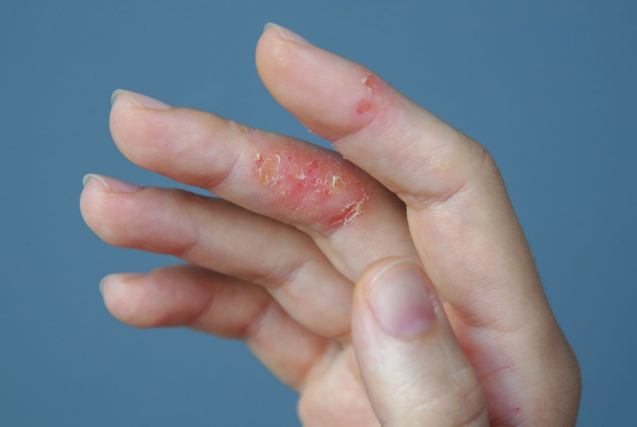 Skin Disorders, Causes & Treatments – Eczema Life