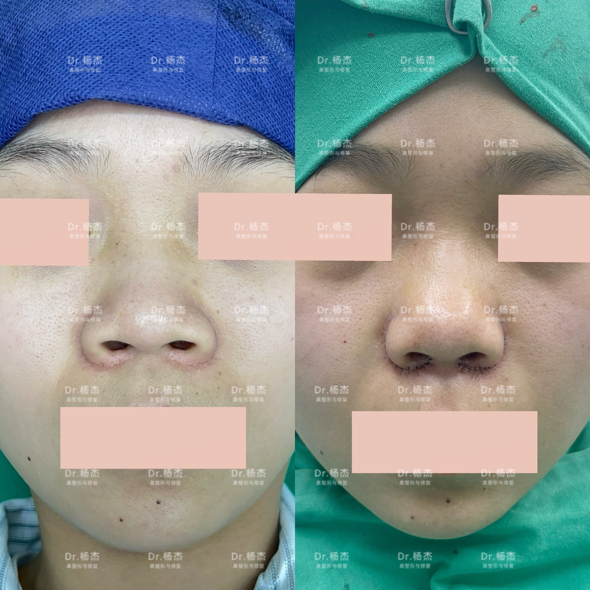 【内外联合鼻翼缩小 鼻槛上提】