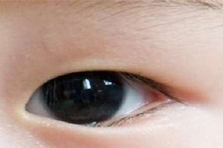 轻度的倒睫,并不打紧.