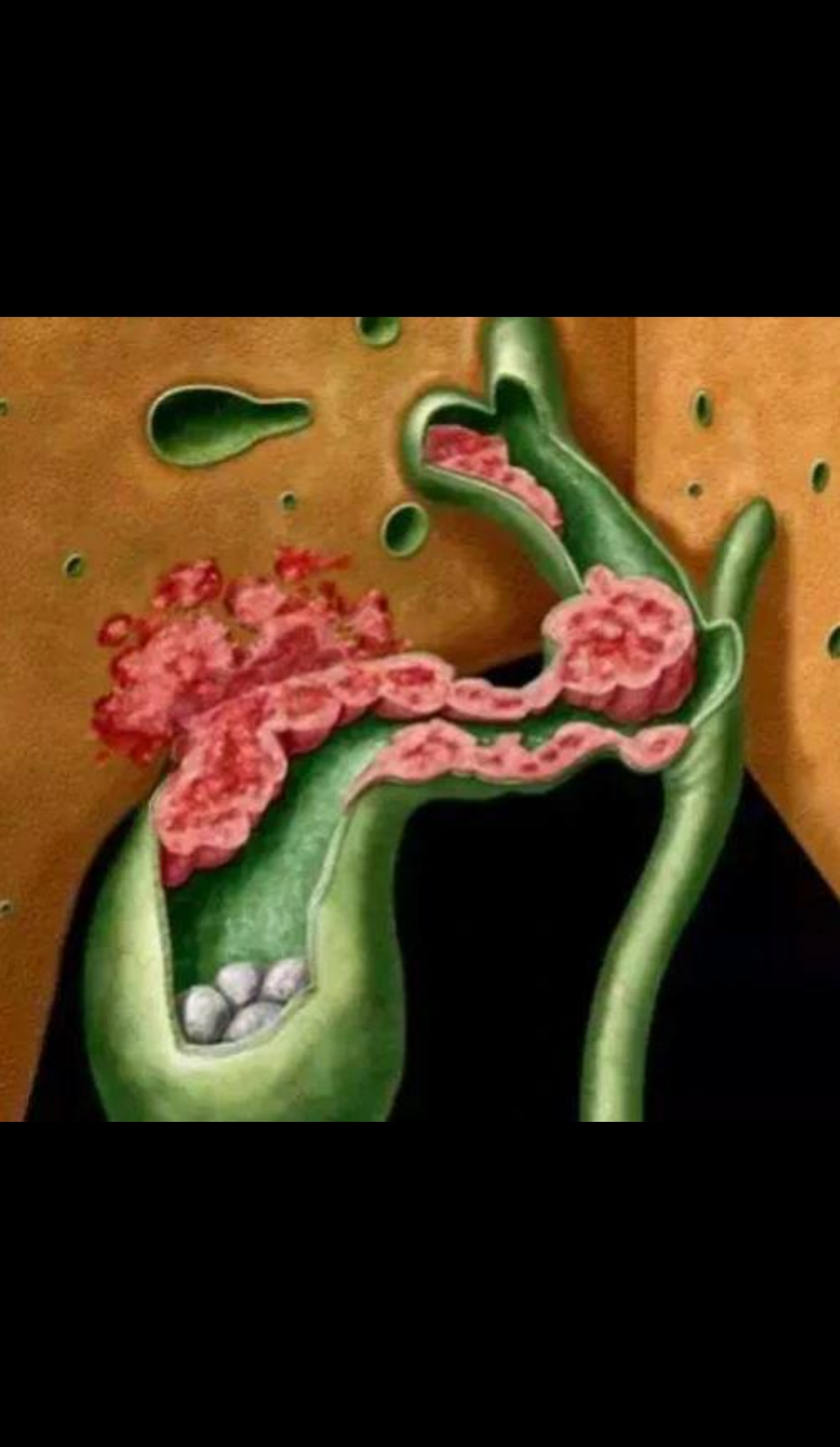 发性硬化性胆管炎,肥胖与糖尿病等;(3)具有胆囊癌危险因素,如胆囊萎缩