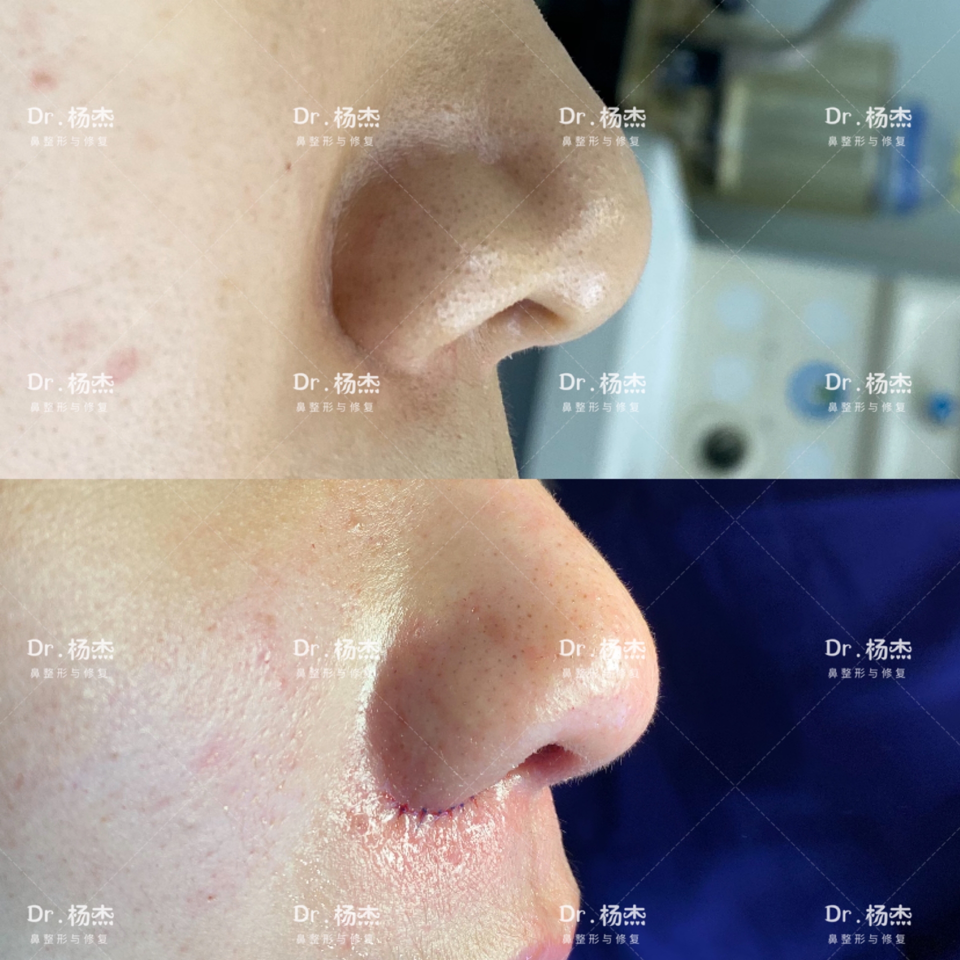 儘量調整鼻翼正面對稱性,兼顧兩側鼻孔對稱性,傷口精細縫合.