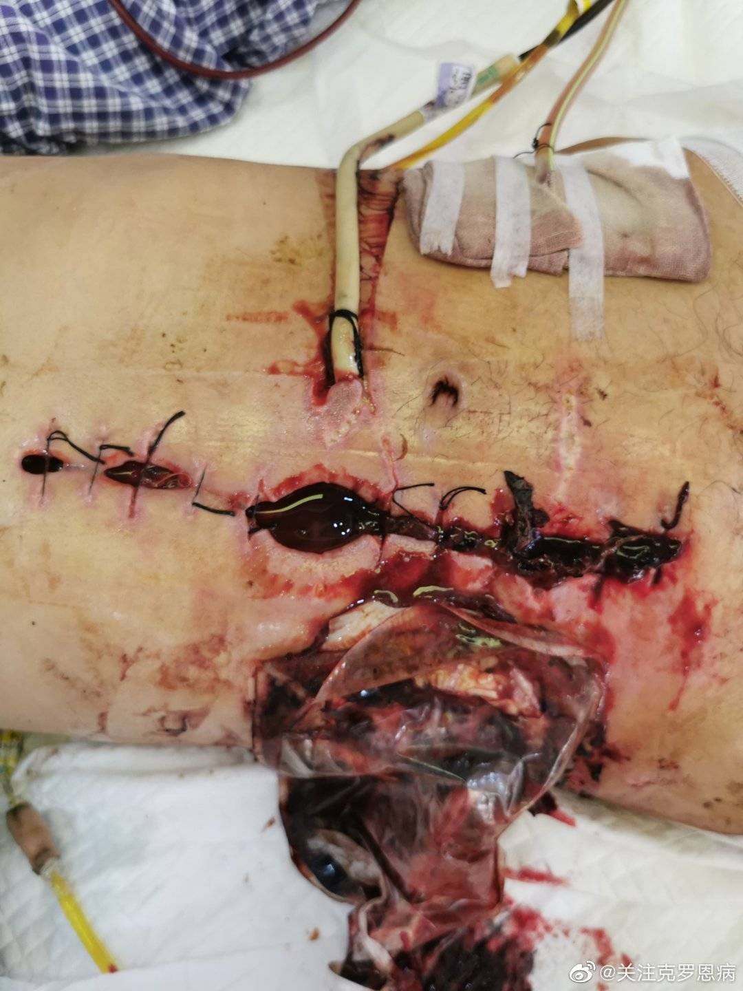 腹腔开放成功救治一例十二指肠瘘合并腹腔大出血患者