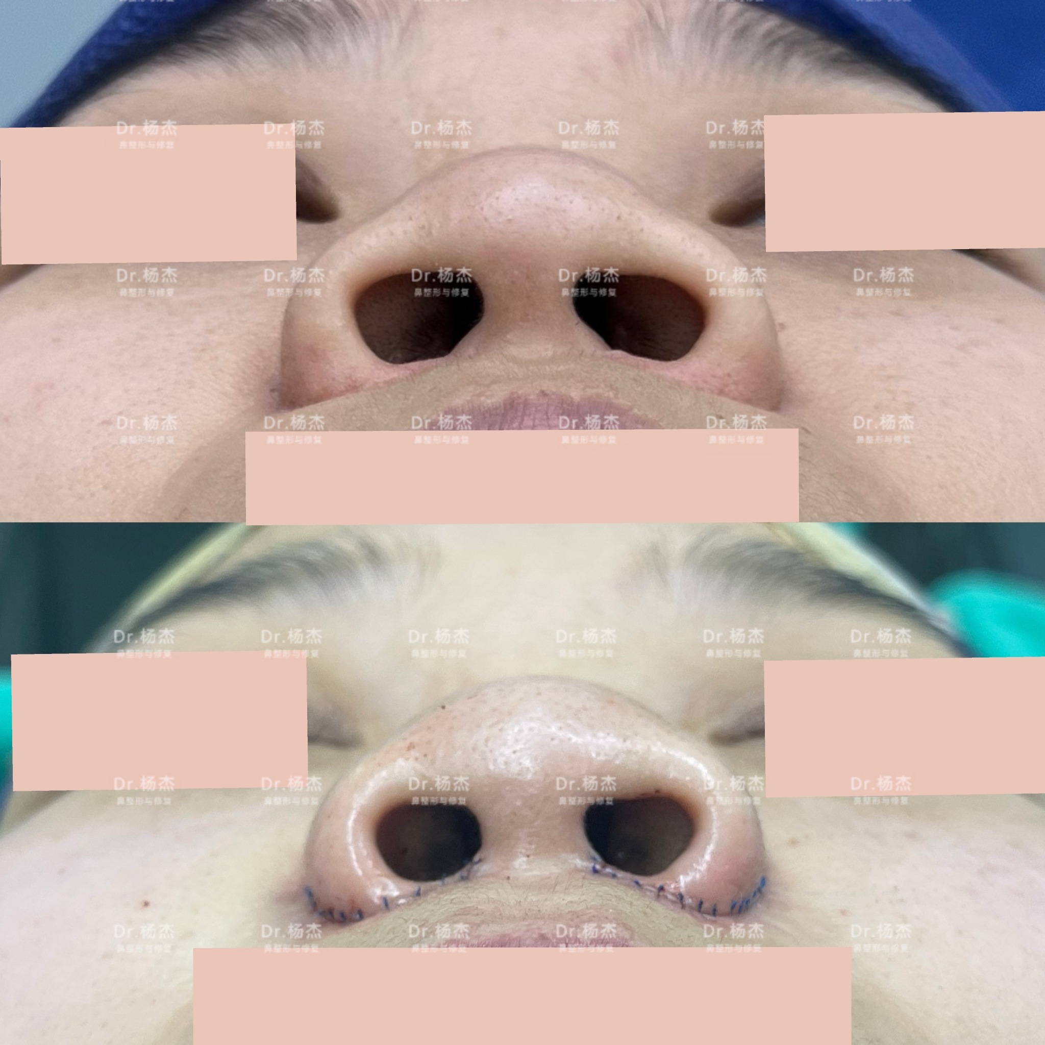 【内外联合鼻翼缩小 鼻槛上提】-杨杰-爱问医生