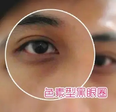 3分钟了解你的黑眼圈怎么回事