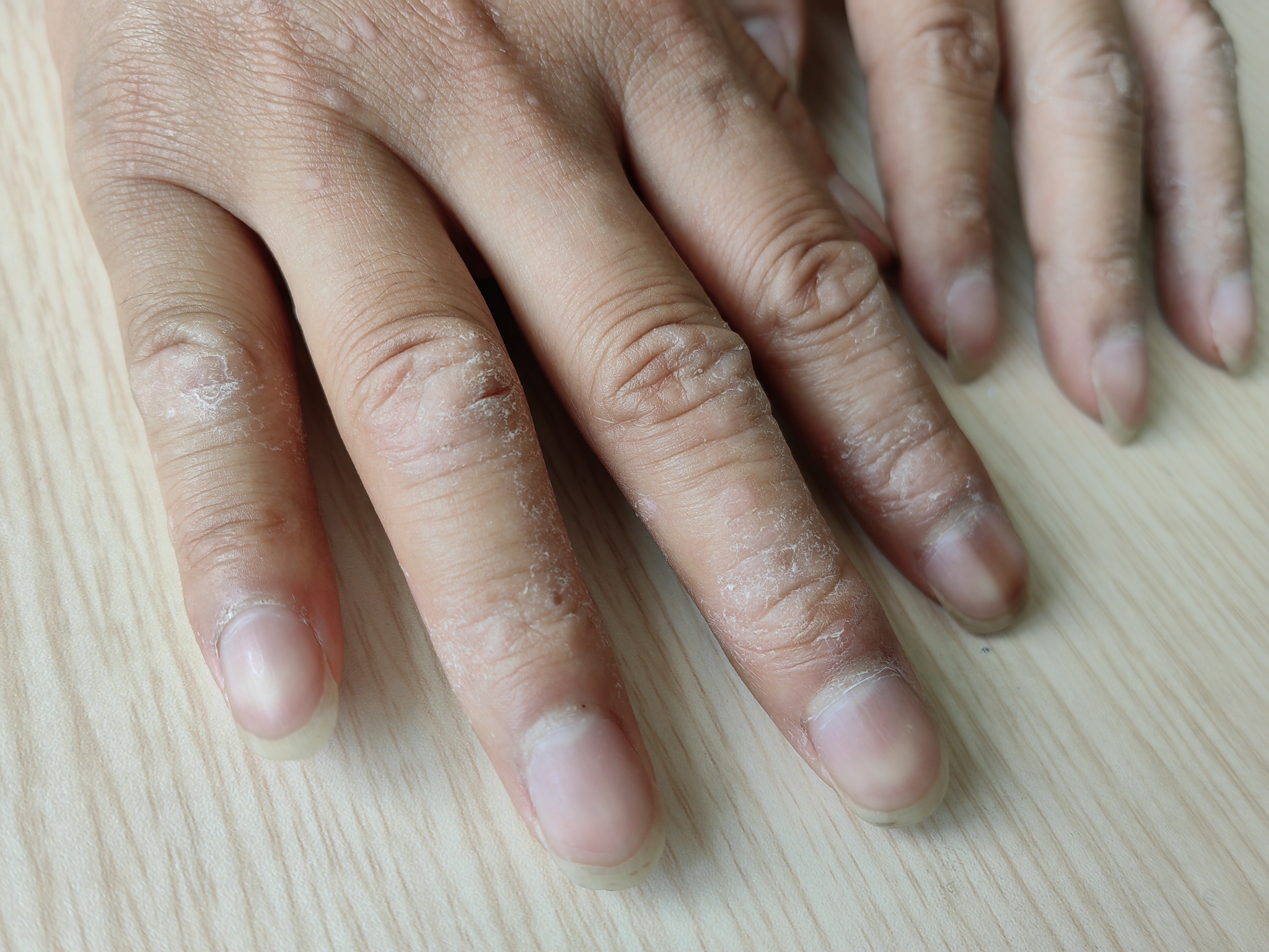 接触性皮炎由迟发型变态反应(过敏的一种)所致,发生在手上常和职业有