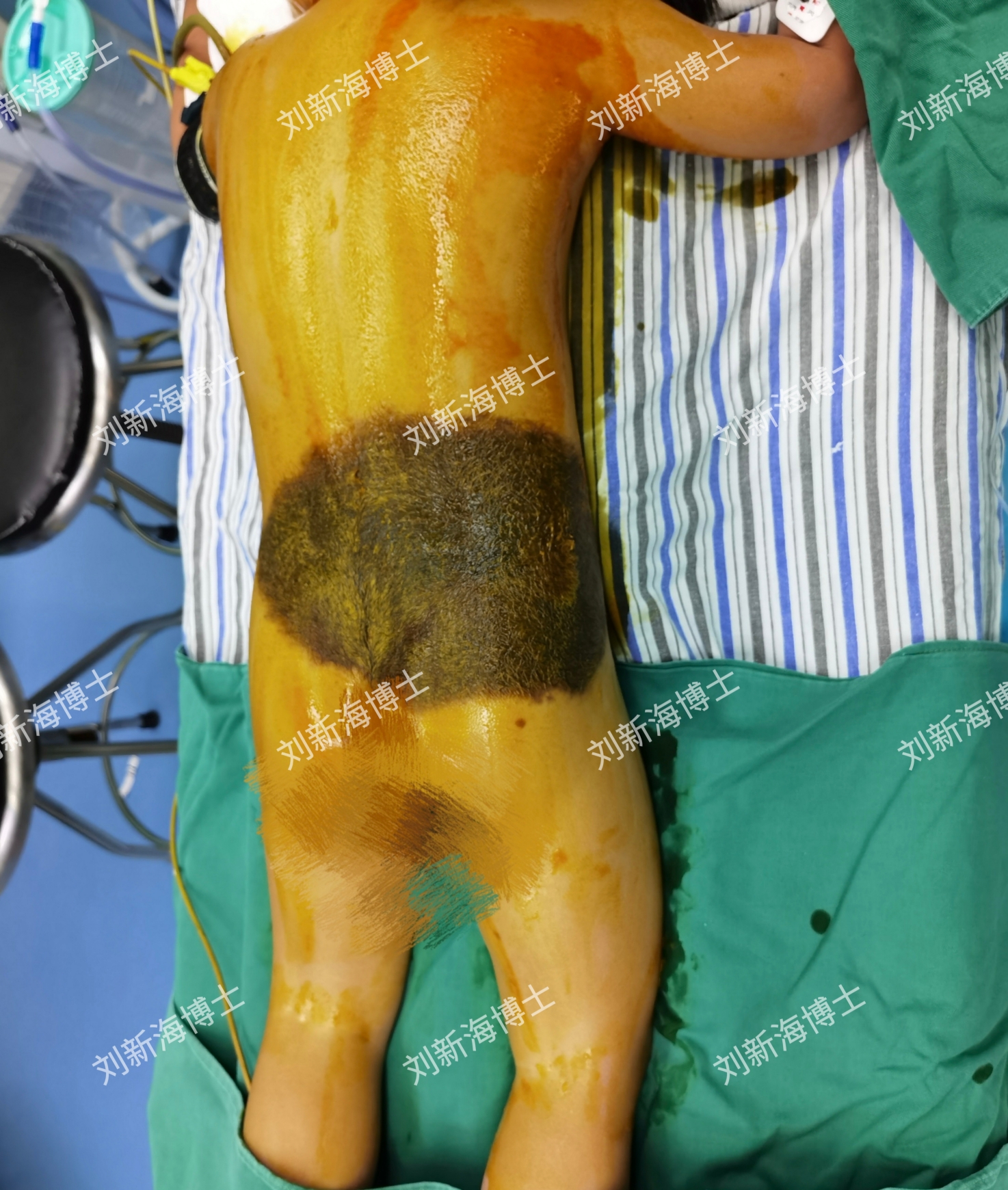 腰部黑痣宝宝皮肤扩张培养