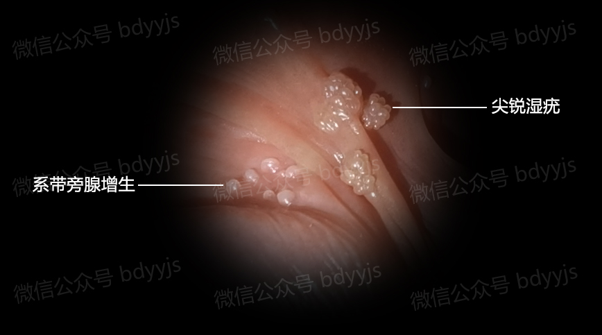 下体尖锐疣湿图片图片