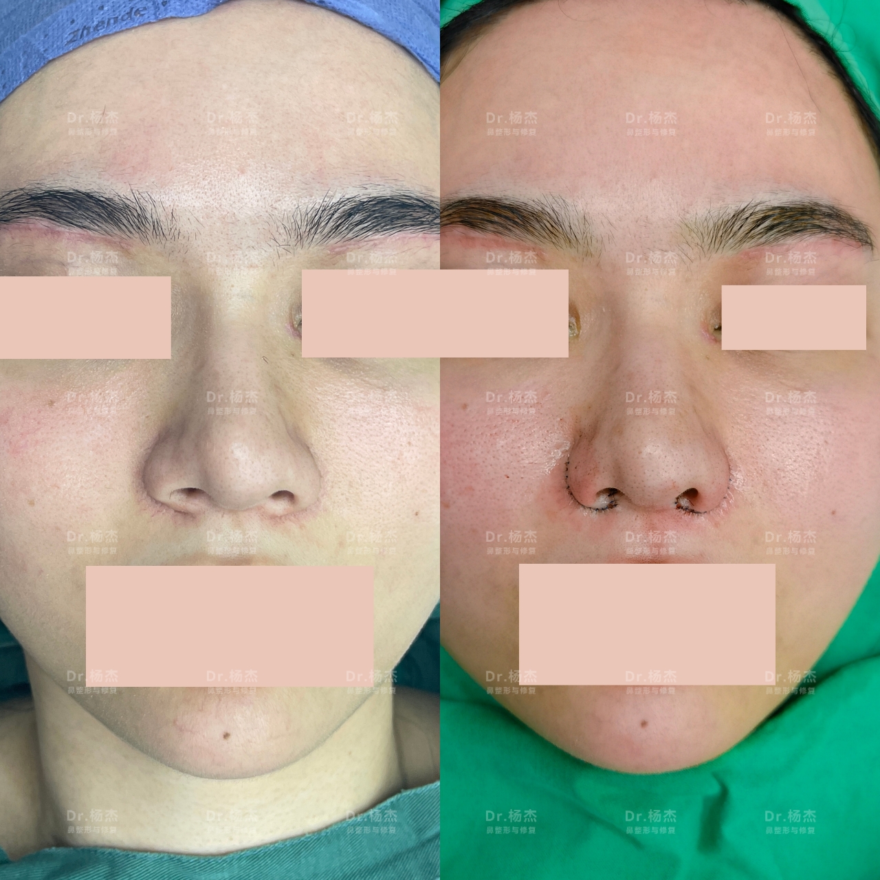 【内外联合鼻翼缩小 鼻槛鼻翼脚上提】-杨杰-爱问医生