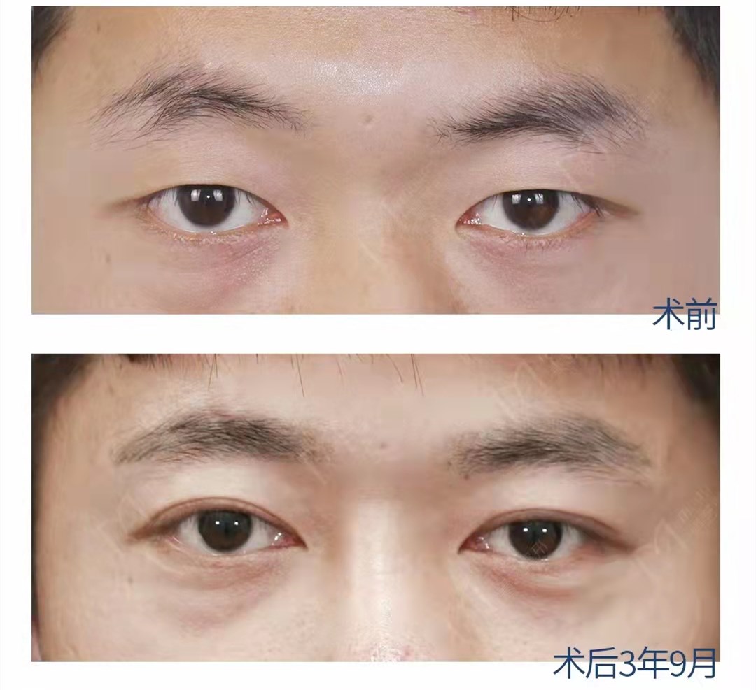 男士双眼皮：男生割双眼皮到底适合多宽才好看？|潘贰双眼皮修复患者故事 - 知乎