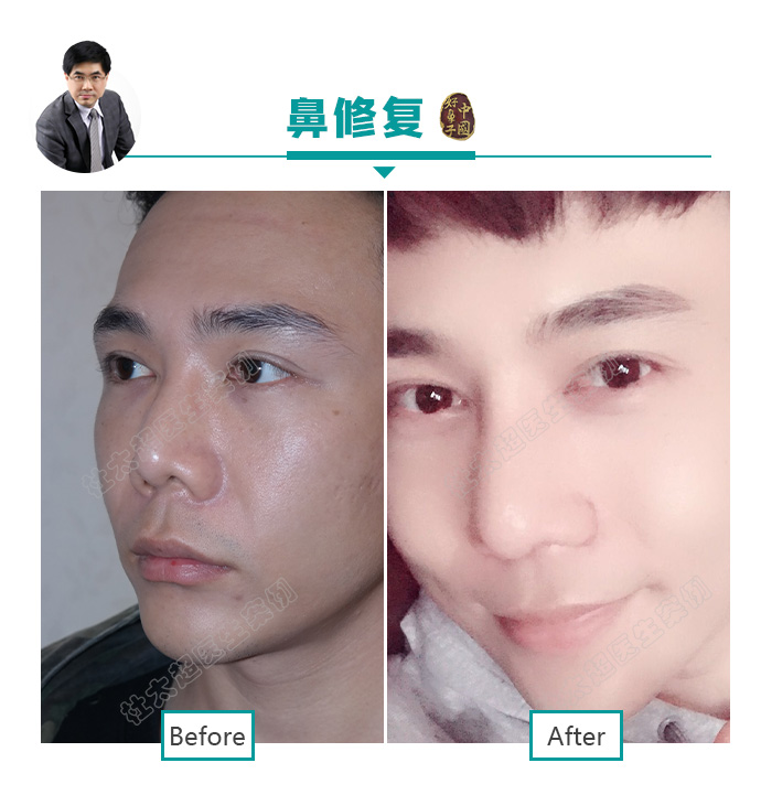 隆鼻 鼻整形并不是女性求美者的专利 杜太超 爱问医生