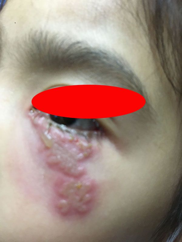 眼部疱疹的症状和图片图片