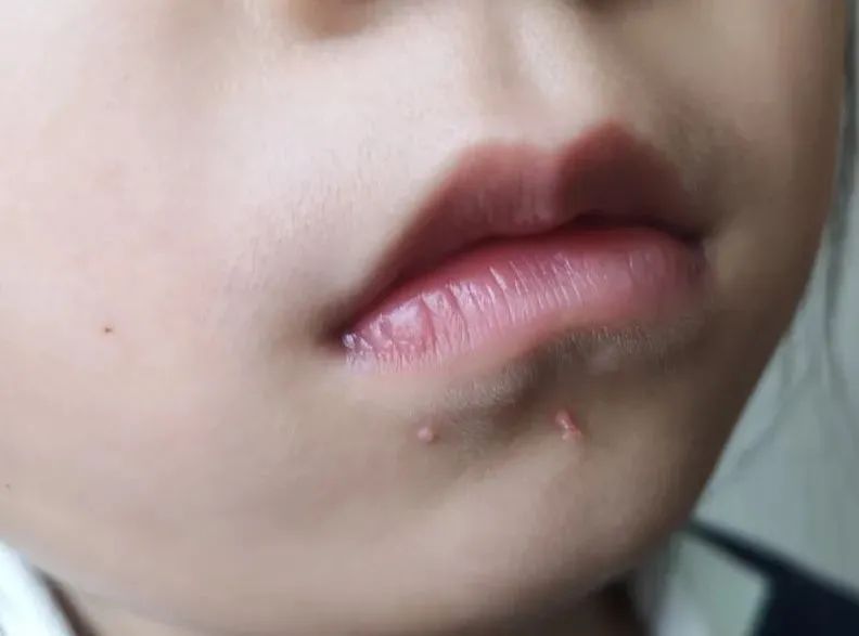 hpv和病毒疣啥模样