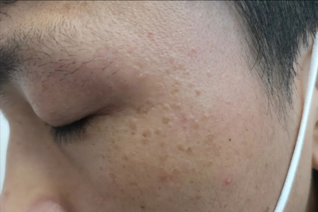 hpv和病毒疣啥模样
