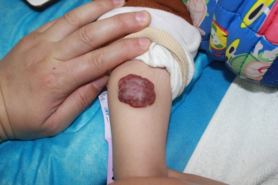 婴儿浅表性血管瘤图片