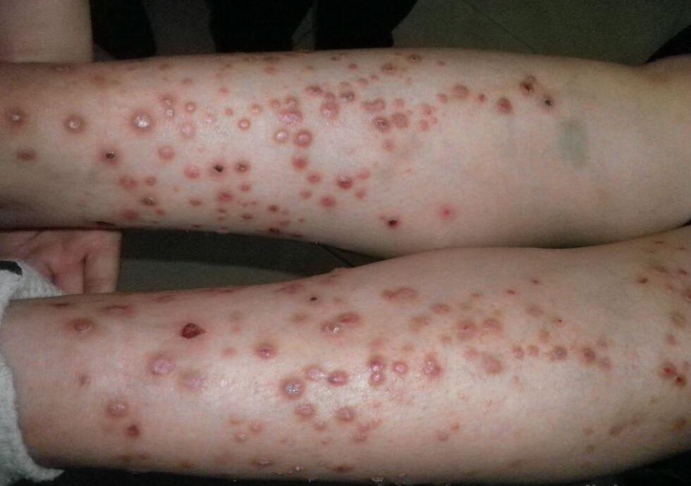 病毒感染的痒疹是图片图片