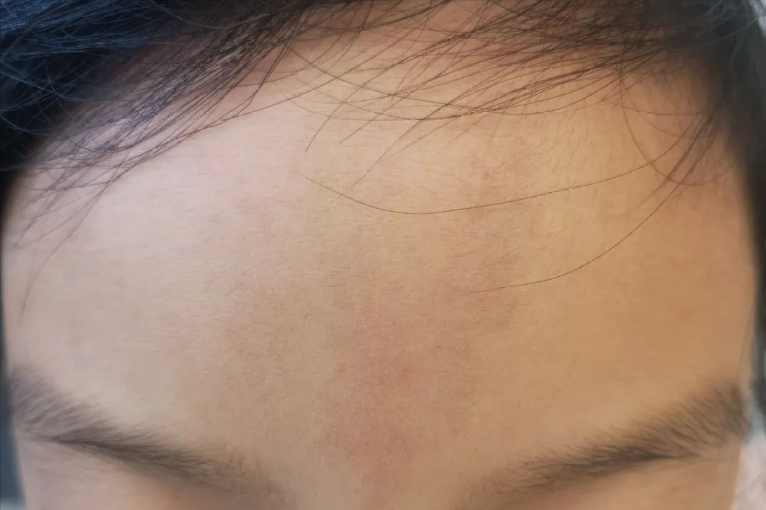 可消退的胎记别成为认亲的遗憾