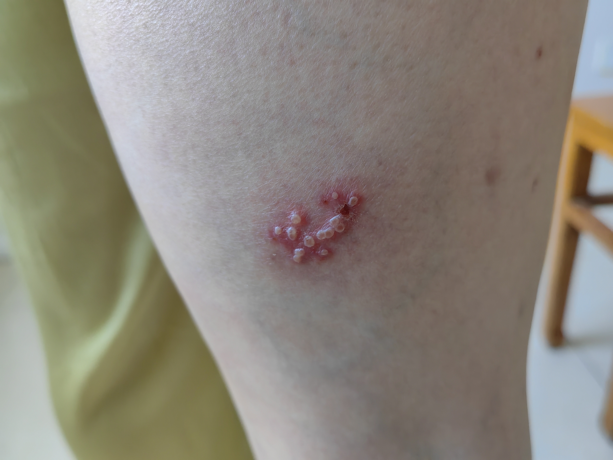 单纯疱疹和带状疱疹怎么区别?-朱敏刚主任医师-爱问医生