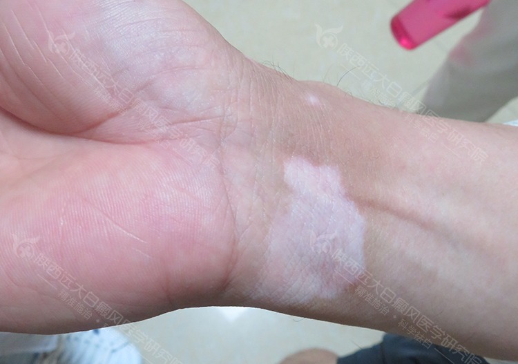 独特的长白斑是缺少什么营养素的图片