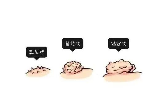 女人菜花状疣能摸出来吗-张磊 -爱问医生