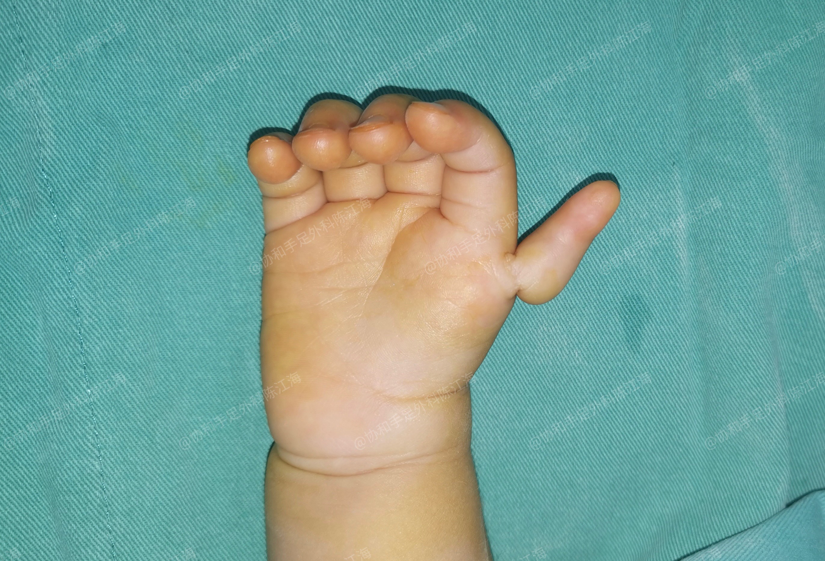 整形显微004：先天畸形---五岁小男孩双手“十二根手指头”_郑元波_副主任医师_爱问健康