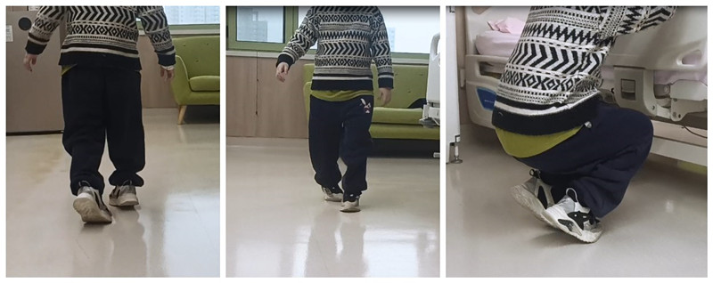 小女孩尖足,马蹄内翻,走路难,"完美梯度疗法"让她能正常行走-常崇旺