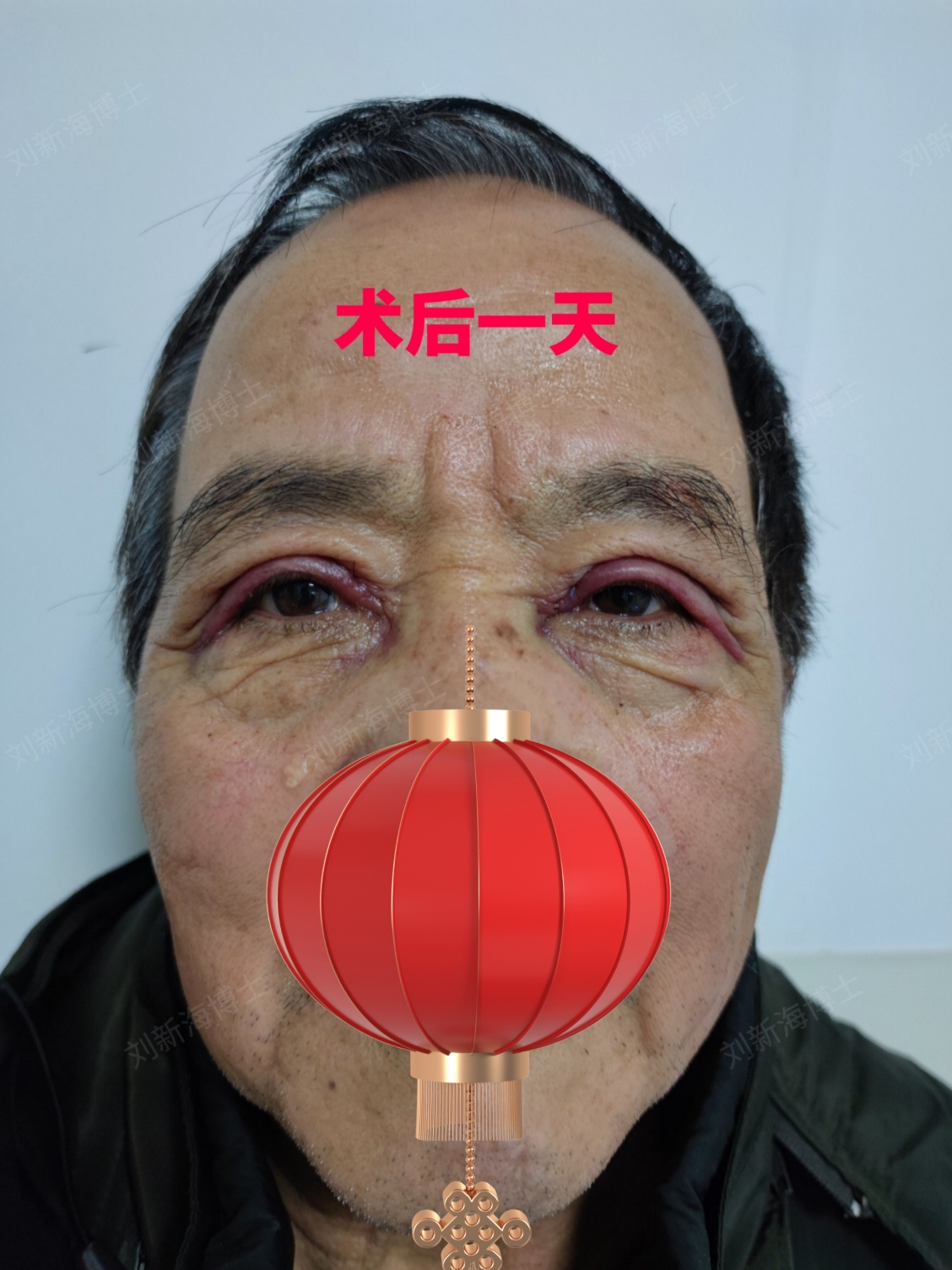 重睑术术后即刻