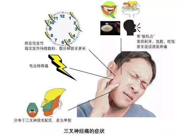 面部电击样疼痛不用忍这些三叉神经痛患者能根治