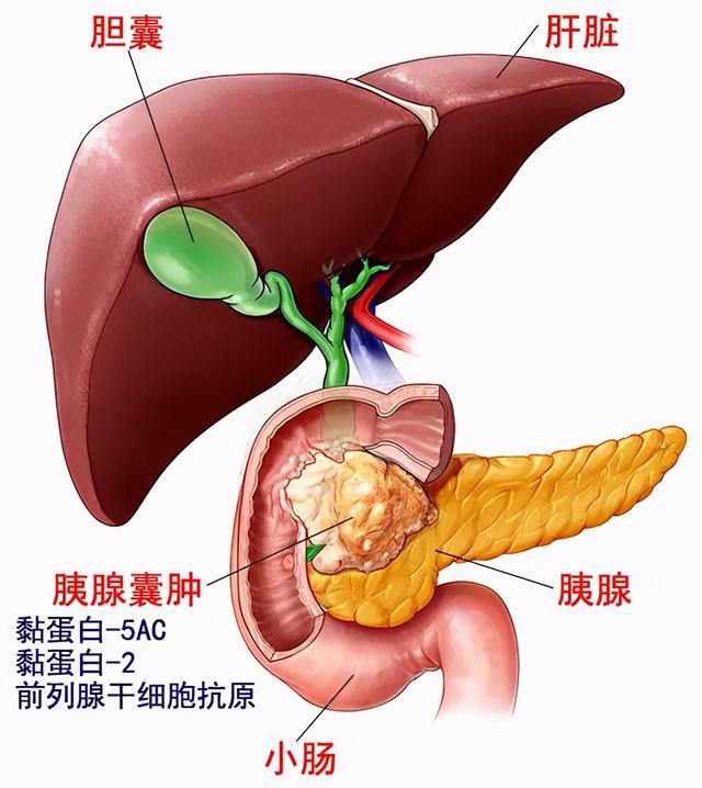 胰腺囊肿分类及相关症状介绍_马大军_副主任医师_爱问健康