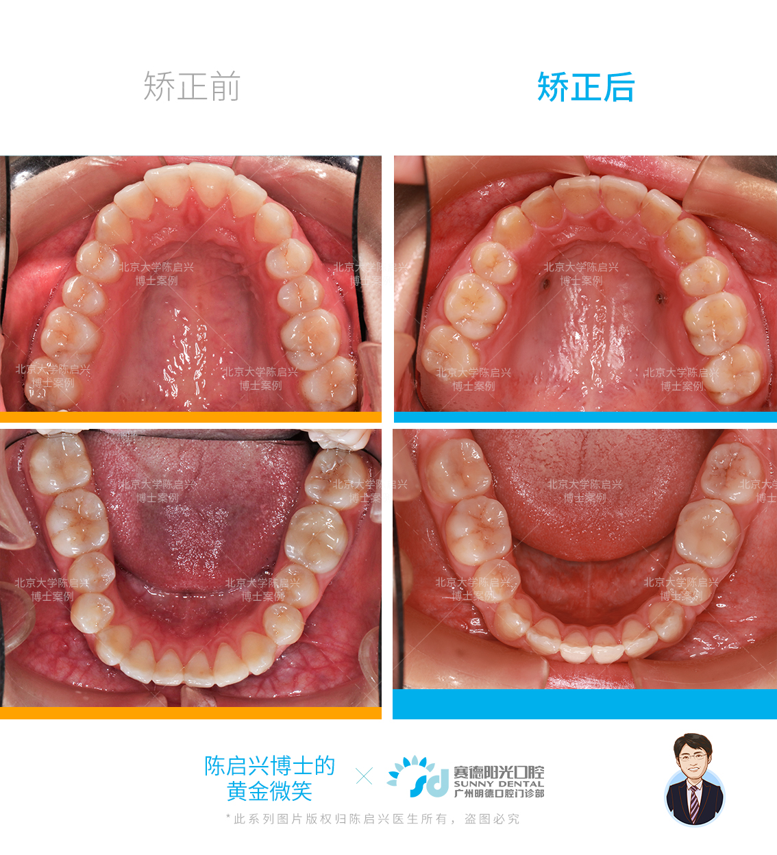 并且由于女生上颌腭盖高拱,上下牙弓宽度不匹配,上牙弓