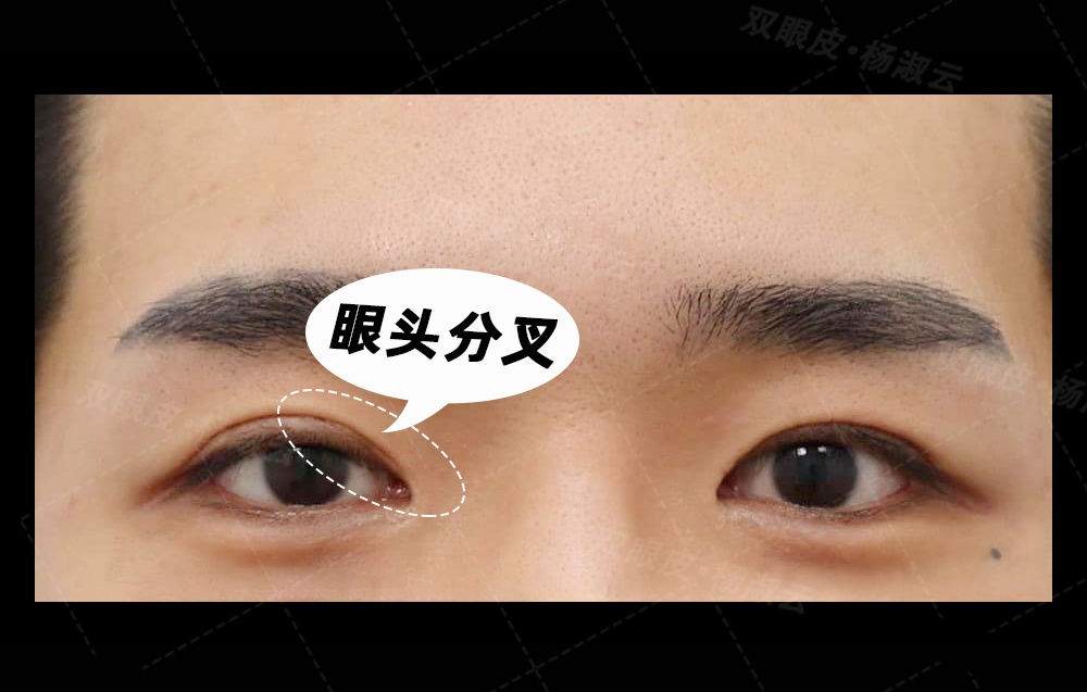 杨淑云双眼皮术后出现眼头分叉怎么办