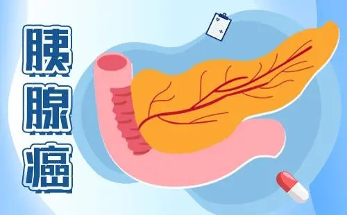 胰腺癌的疼痛與其他疾病導致的腹痛如何區分?