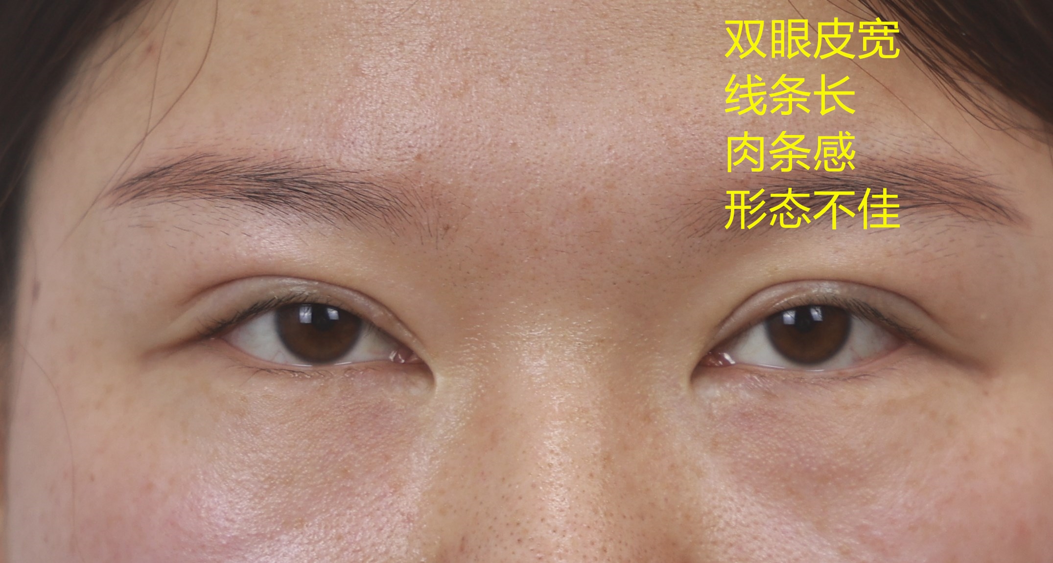 全切双眼皮修复第三次修复分析：双眼皮宽、假、凹陷性瘢痕明显。-孔宇主任医师-爱问医生