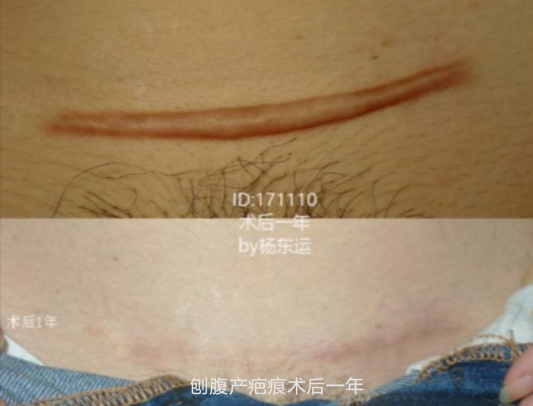 疤痕切除术后 恢复全过程-刘新海副主任医师-爱问医生