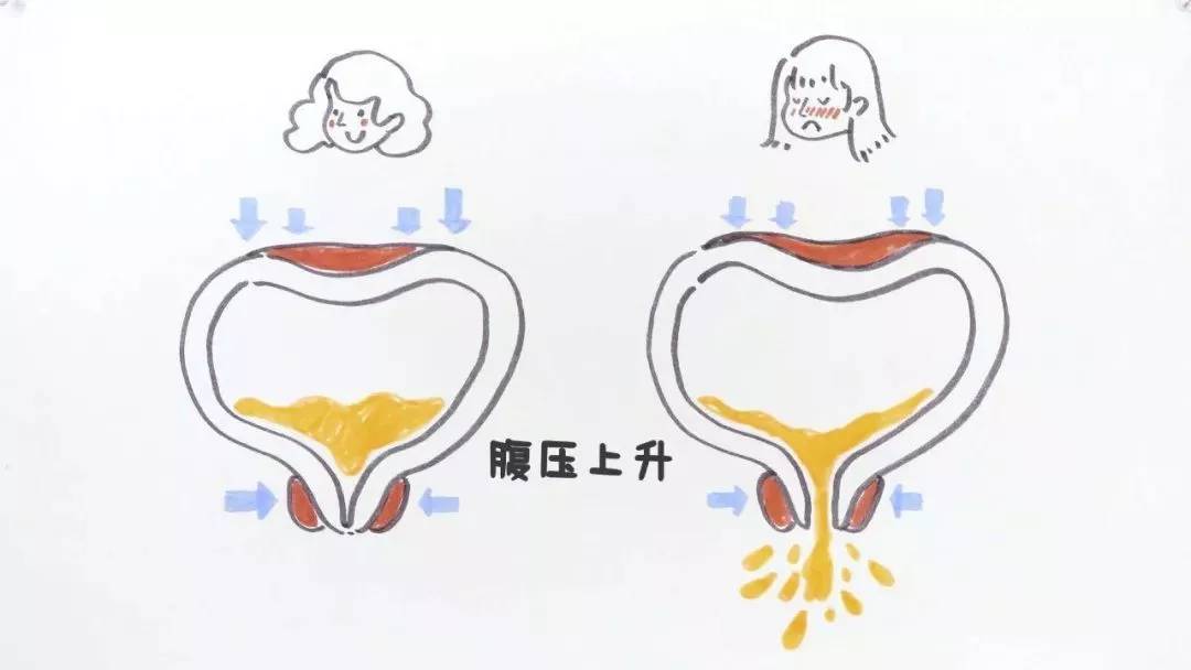 如果是低压的膀胱,尿道阻力不是很大,可以采用外括约肌肉毒素注射的