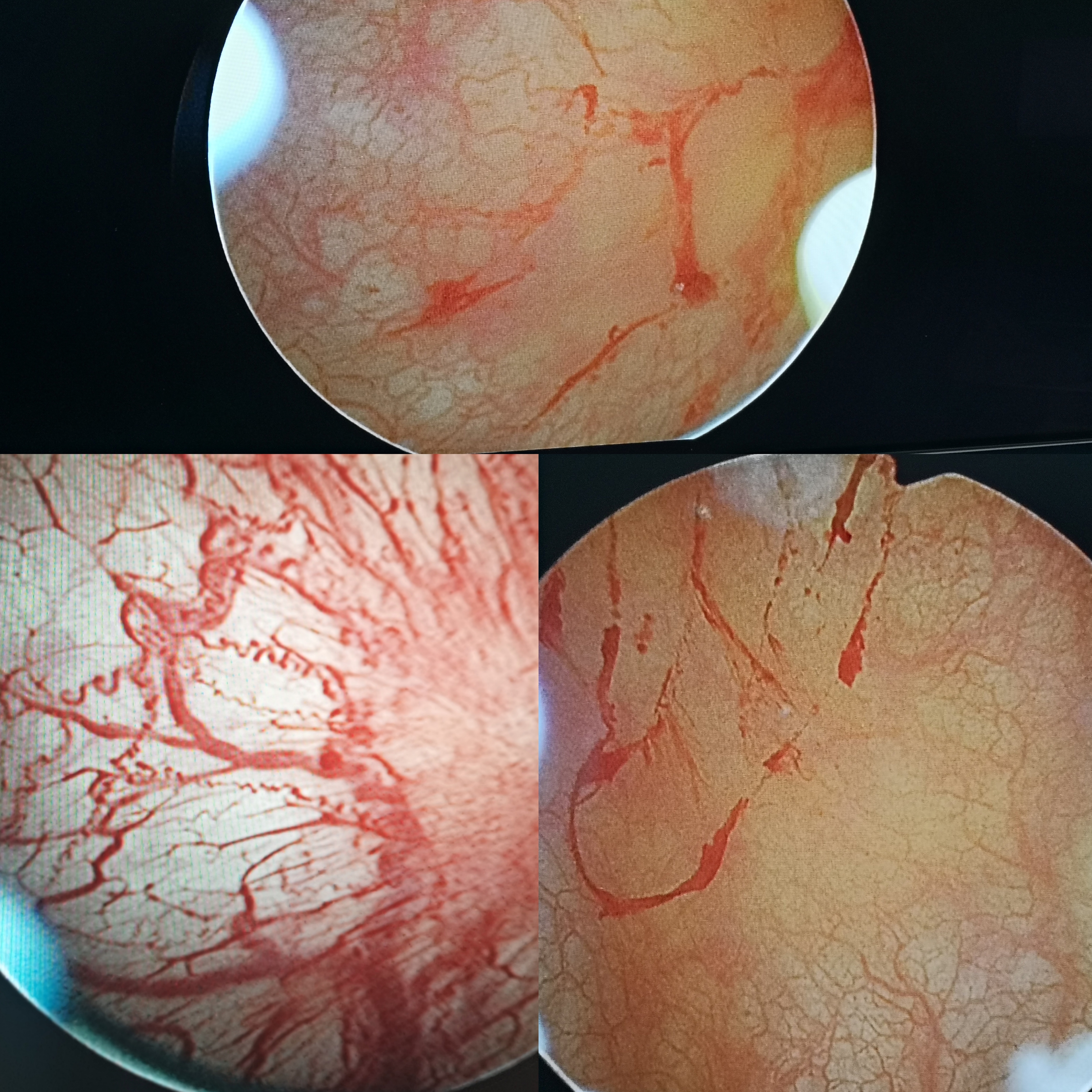 典型病例 间质性膀胱炎让患者有多痛苦 一位岁老太亲述 李旭东副主任医师 爱问医生