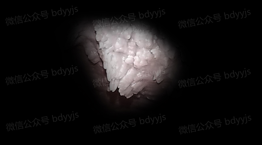 尖湿锐尤早期图片女性