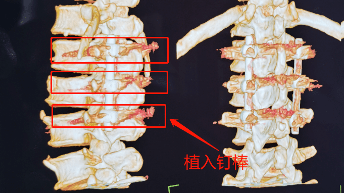 據賈棟院長介紹,腰椎骨折切開復位內固定術,因其具有手術切口小,出血