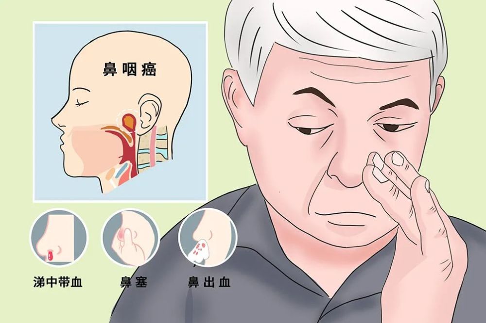 鼻咽癌早期症状图片