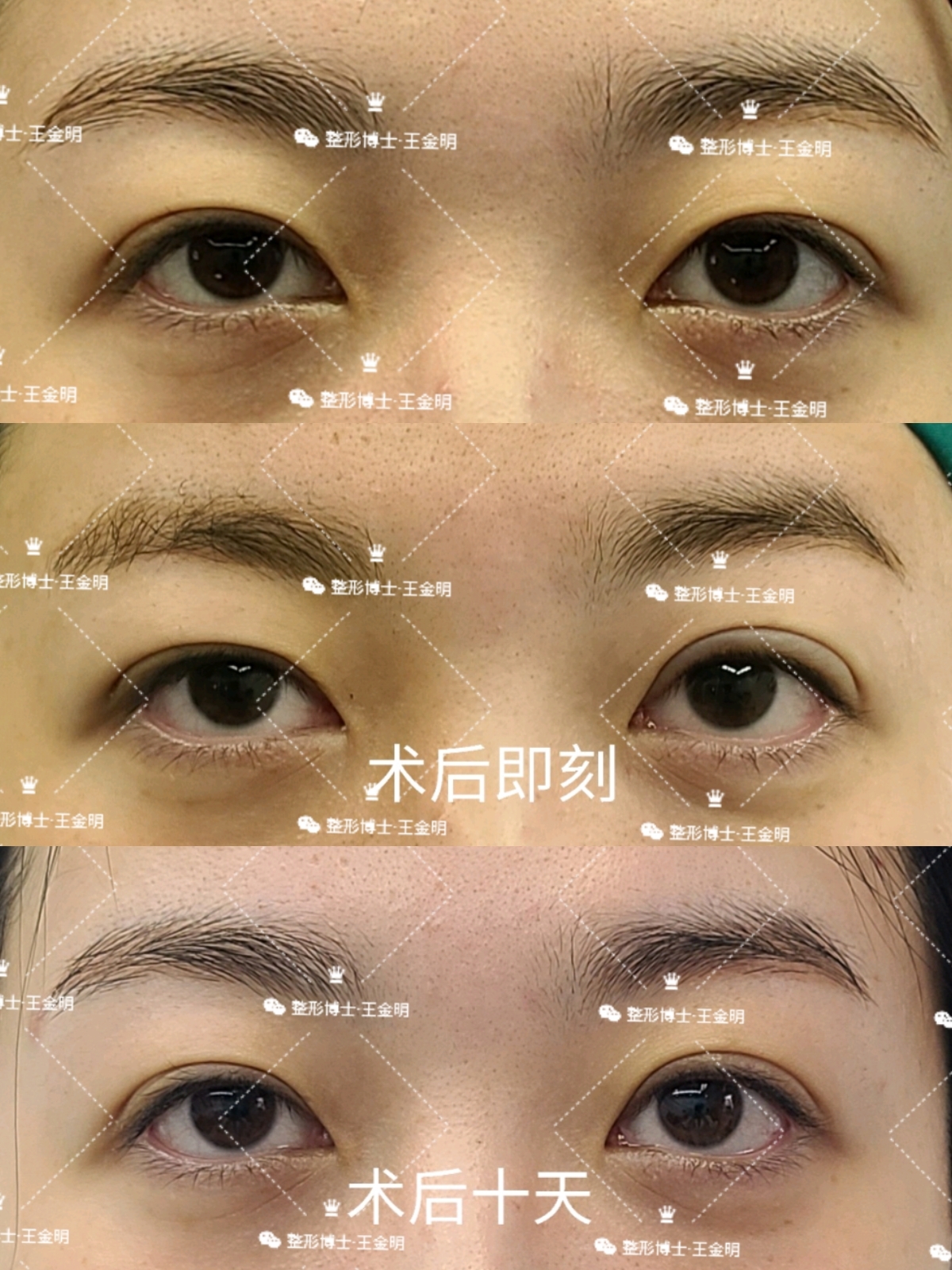 郑州双眼皮手术 - 知乎