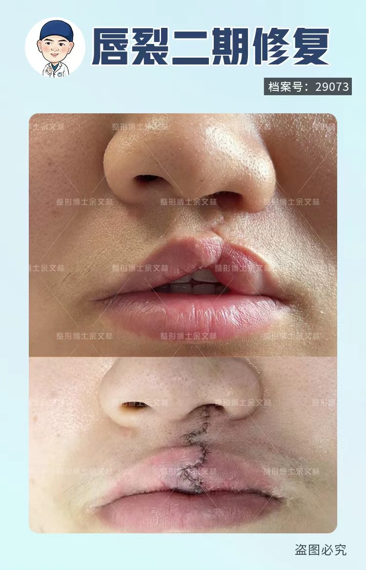 案例分析唇裂术后出现口哨样畸形19岁女生做手术改善