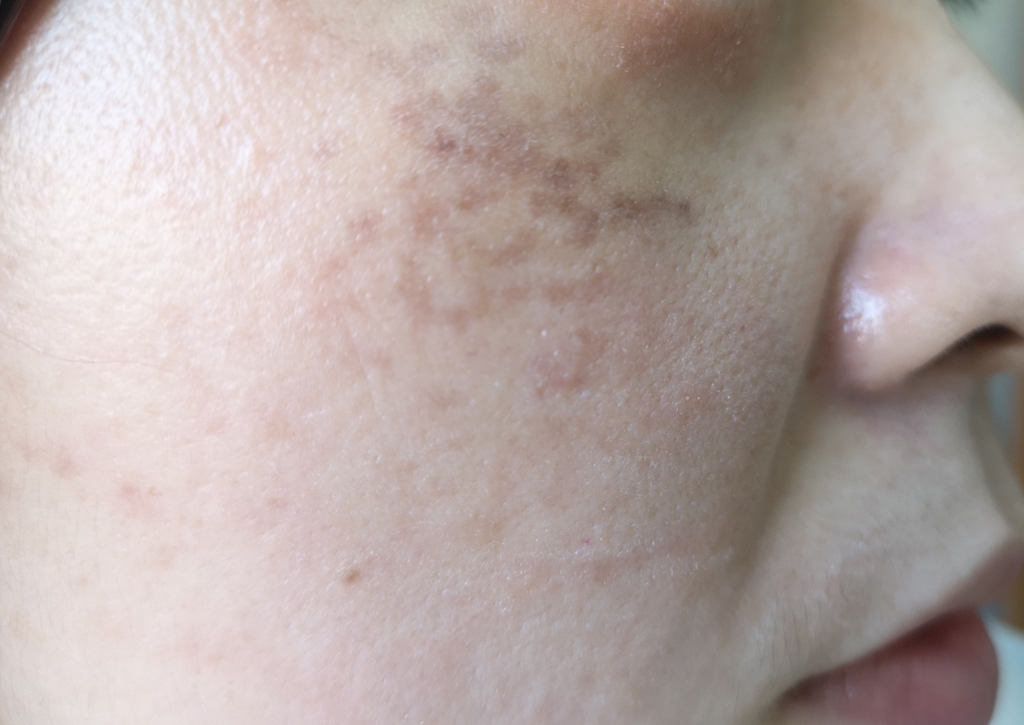 眼周反复红肿瘙痒 脸上还有斑斑点点 原来是 朱敏刚主任医师 爱问医生 眼周反复红肿瘙痒 脸上还有斑斑点点 原来是 朱敏刚主任医师 爱问医生