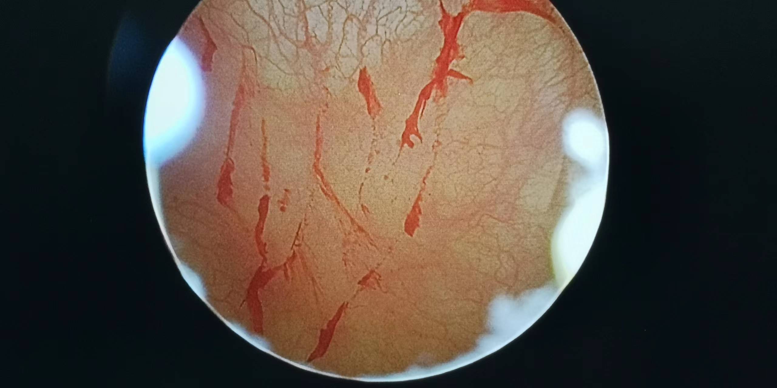 出血性膀胱炎の症状