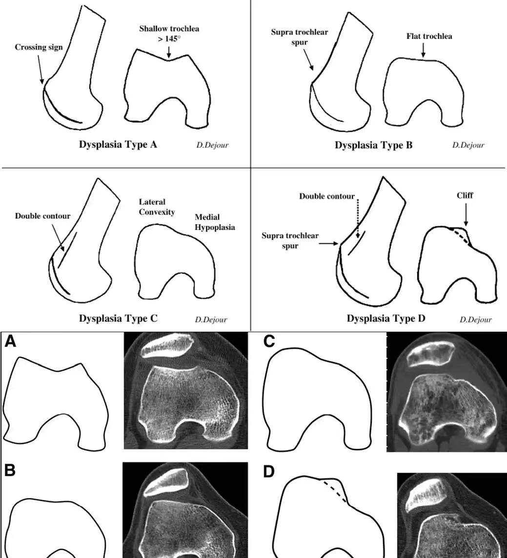 较浅的股骨滑车会使髌骨失去髁间沟提供的向外脱位的骨性支撑从而增大