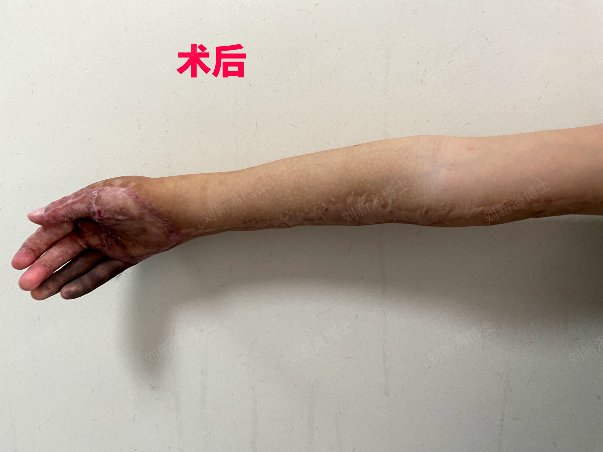 胳膊巨痣皮肤扩张培养术后恢复全过程