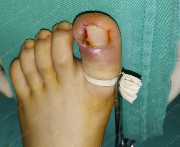 嵌甲要及早正确治疗,拔甲不是首选方案,具体如何治疗视情况而定-陈江