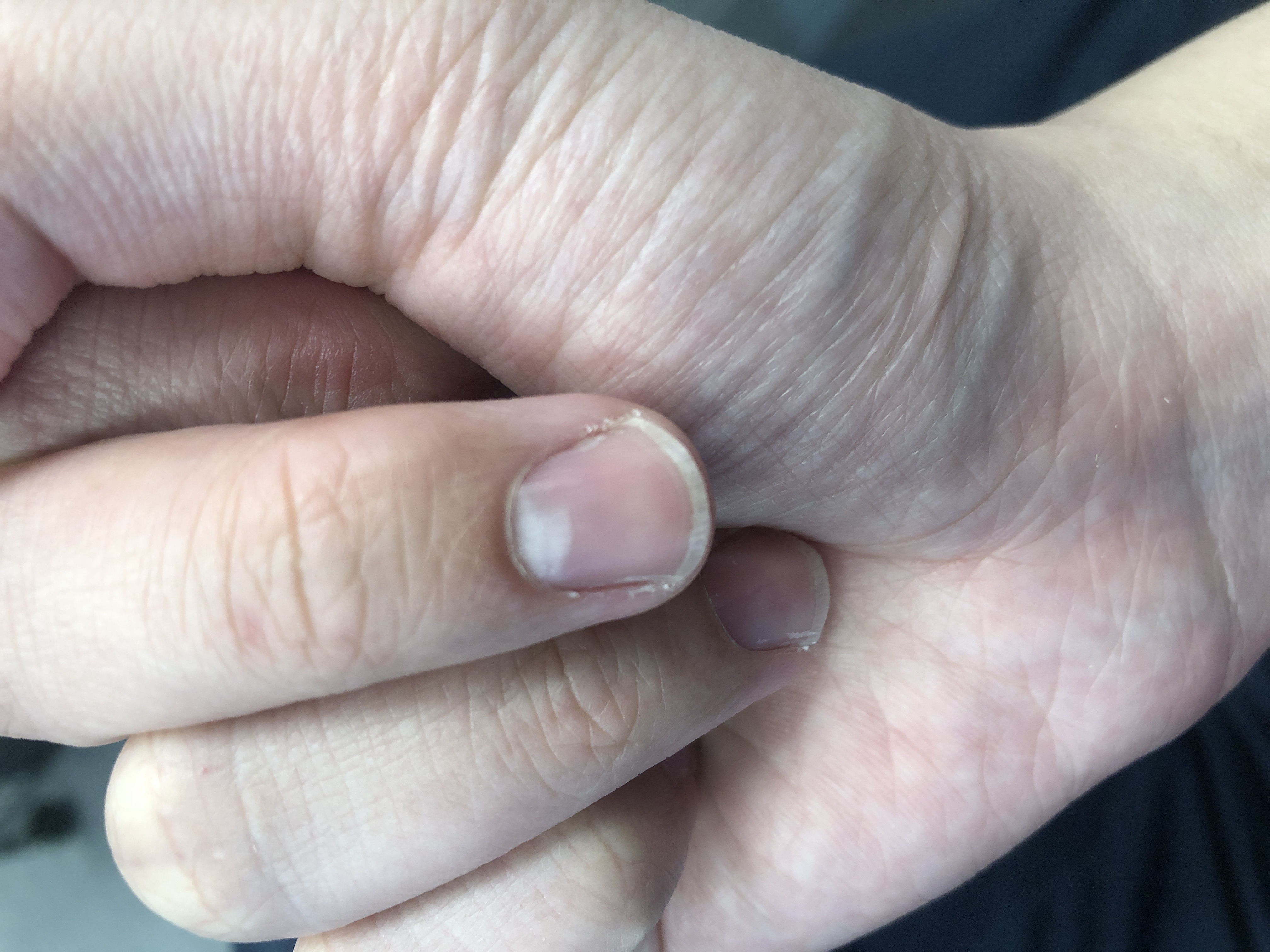 指甲的半月牙扩大了这是什么情况