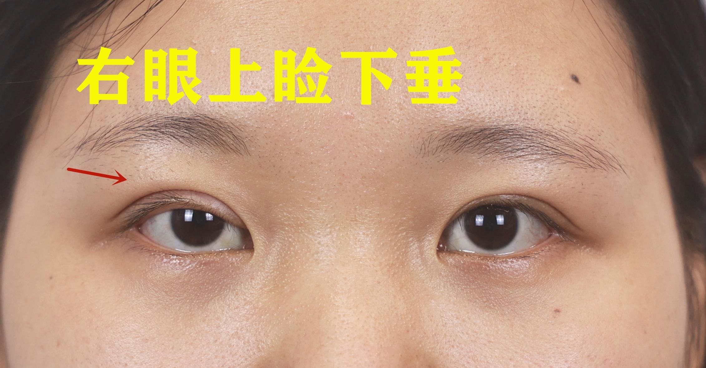 【全切双眼皮、上睑下垂矫正】上睑下垂， 左侧轻度，右侧中度（术后11个月反馈 - 知乎